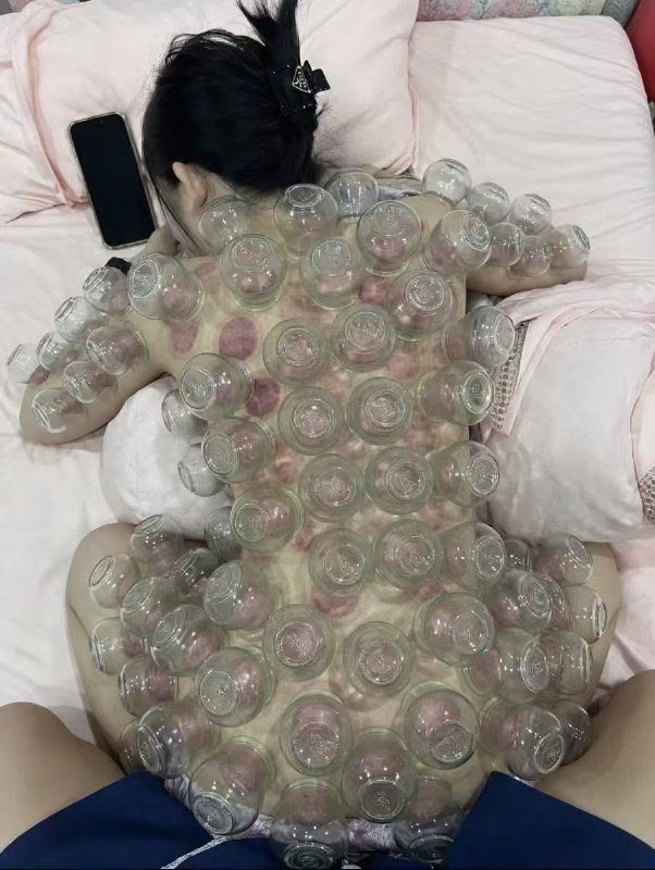 #拔火罐 是不是有点密集了